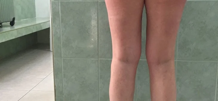 Dile adiós a la celulitis Dile adiós a la celulitis